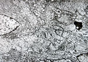 F,25y. | giant multinuclear osteoclast - aneurysmatic cyst - tibia